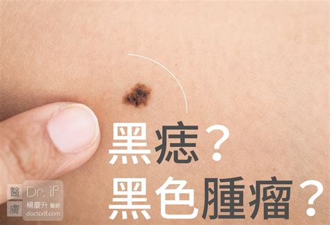 臉上長誌|不大驚小怪！如何辨別「黑痣」與「黑色腫瘤」？ 